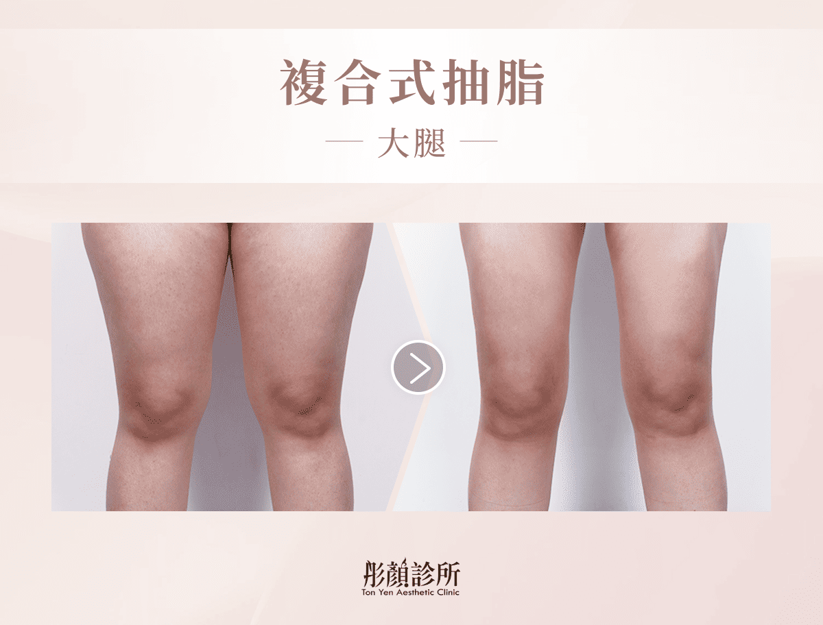 複合式抽脂（大腿）